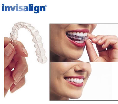 invisalign2